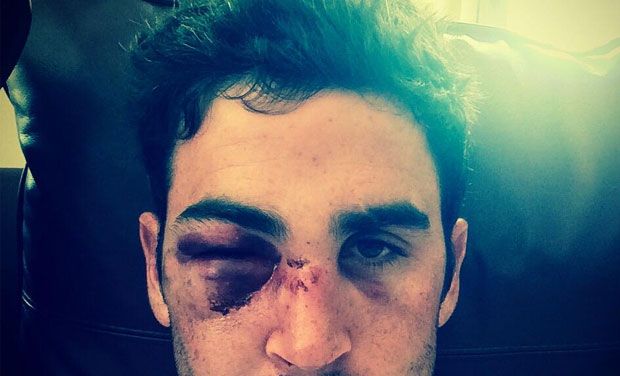 Craig Kieswetter damaged his eye socket when a ball smashed through his helmet grill, breaking his nose and injuring his cheekbone while batting against Northamptonshire. (Photo: Twitter) Craig Kieswetter damaged his eye socket when a ball smashed through his helmet grill, breaking his nose and injuring his cheekbone while batting against Northamptonshire. (Photo: Twitter)